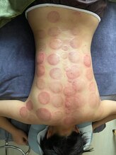 中国整体 らくらく堂/人気★遠赤外線吸い玉+カッサ