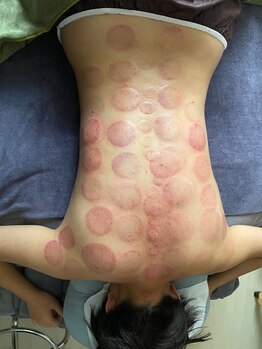 中国整体 らくらく堂/人気★遠赤外線吸い玉+カッサ