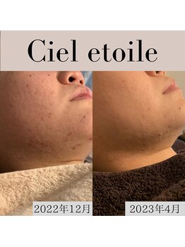 シエルエトワレ/【ニキビ特化】改善コース