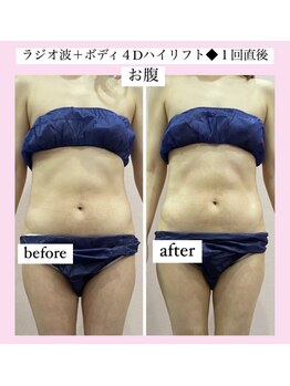 ルピナス ヒサヤ(LUPINUS hisaya)/4Dスーパーリフトはボディにも☆