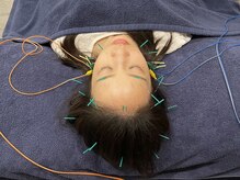 ビースタイル(B-style)/【美容鍼灸】電気美容鍼灸施術