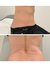 ユウキ(yuuki)/痩身after