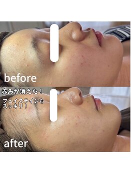 エムアイ 六本木(Mi)/赤みケア／水光ピール