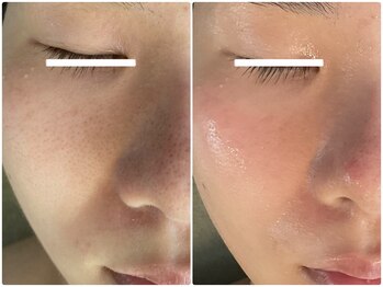 ルミエール フォレストサイド(L’MIERE forestside)/毛穴を小さく目立たなく!