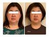人気No.1【ほうれい線・二重顎根本改善】小顔矯正+頭蓋骨矯正 70分　初回体験