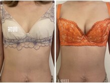 ルフルリール(Refleurir)/◆バストアップ症例/育乳◆