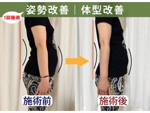 レシカ/1回の施術で反り腰姿勢改善