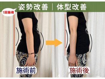 レシカ/1回の施術で反り腰姿勢改善