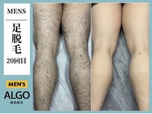 アルゴ 飯塚店(ALGO)/足脱毛