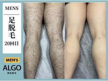 アルゴ 飯塚店(ALGO)/足脱毛
