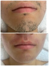 ピーナップ(P-nap)/髭脱毛