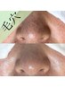 【フェイシャル】いちご鼻に★毛穴エクストラクション通常¥11000→