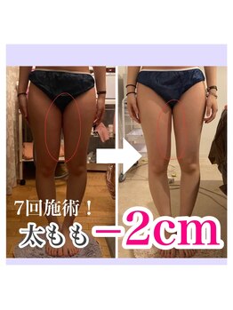 アンリール 旭川店(Anrire)/BODY施術のお客様です!