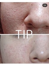 ビーピー 渋谷(b.p.)/ハーブピーリング