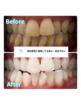 ホワイトニングショップ 甲府店/ホワイトニングの効果