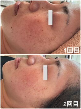 美バストアルファ(美bust α)/【シミケア】症例