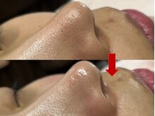 ブリリアン デイスパ 阪急西宮ガーデンズ店(BRILLIAN DAYSPA)/毛穴洗浄フェイシャル