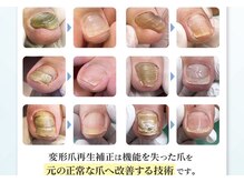 巻き爪補正店 鹿児島店の雰囲気（変形爪再生補正：機能を失った爪を元の正常な爪に改善する施術）