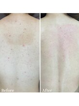 ニキビケア研究所 横浜店/赤みや背中ニキビでお悩みの方へ