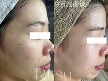 リツ(Ritsu)/ニキビケア/ざらつき