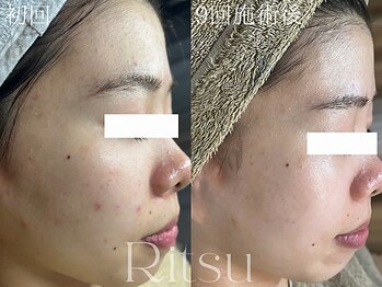 リツ(Ritsu)/ニキビケア/ざらつき