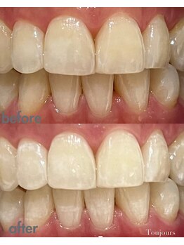 トゥジュール(Toujours)/医療提携ジェル4回