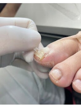 牛久巻き爪センターの写真/巻き爪/厚爪/深爪/変形爪など諦めていた爪に負担のない施術でお悩みを解消◎正常な爪へ！