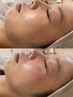 【相談して決める】カウンセリング&当日施術