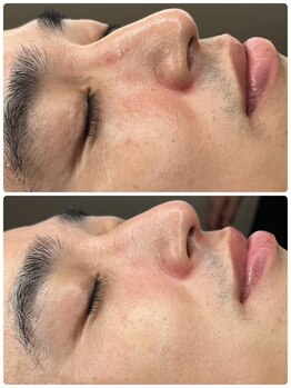 ユーイン 塩尻店(U-in)/ララピールビフォーアフター