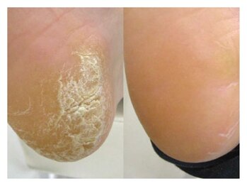 巻き爪ケアサポート ルアナ(LUANA)/Before→After