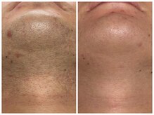 フェリス(FELIZ)/1日に一回が月一になるヒゲ脱毛