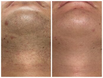 フェリス(FELIZ)/1日に一回が月一になるヒゲ脱毛