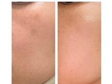 アンシャンテ(Anchant)/【ダクトピール（水光肌）】