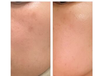 アンシャンテ(Anchant)/【ダクトピール（水光肌）】