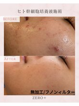 ゼロプラス(ZERO+)/【フェイシャル】ZEROヒト幹細胞