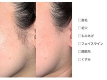 ピュアノア 三木店/もみあげ|全身脱毛　三木|小野