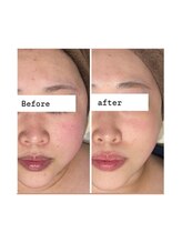 アリス(ALICE)/赤ら顔にはハーブピーリング