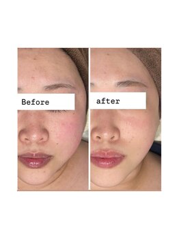 アリス(ALICE)/赤ら顔にはハーブピーリング