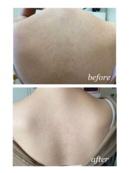 オアジスパ(Oasi Spa)/DTありハーブ５回Beforeafter