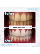 ホワイトニングショップ 甲府店/ホワイトニングの効果