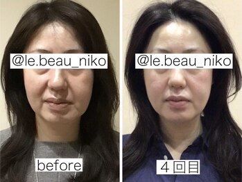 ミー(Mi)/お肌を10歳引き戻す美容鍼