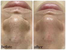 ユウ 尾張旭店(U)/エンビロン毛穴ケア