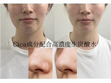 毛穴洗浄後は、美容成分が浸透しやすくツヤ肌に♪