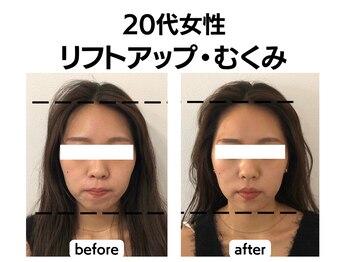 シン(SHINE)/美容鍼灸プレミアム