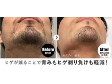 RBL イオンモール盛岡店/メンズ脱毛/ヒゲ脱毛2回目剃毛後