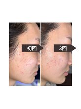 アルビーダ(RBDA)/肌荒れも対応！