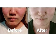 ハピエスト 御坊店/PHA・水光ピールトリートメント