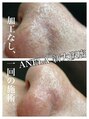 アネラ(ANELA)&nbsp;新技法エクストラクション(毛穴チュチュル)は1度で結果が出ます!