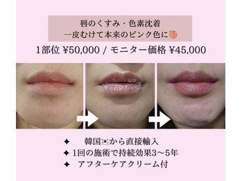 アイル 代々木上原店(iru)/唇のくすみケア¥45,000