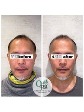 キュープ 相模原淵野辺店(Qpu)/たった4回で人生で1番小さな顔に